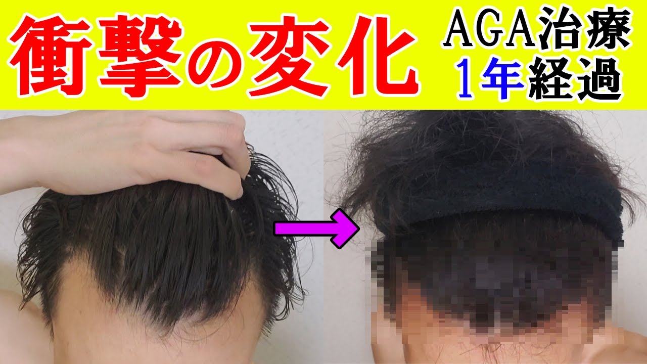 【衝撃】薄毛に悩む人必見！AGA治療1年の効果がヤバ過ぎ！個人輸入で大丈夫です。